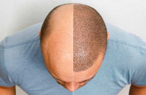 Chemical Peel
