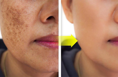 GFC Treatment